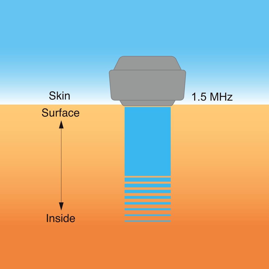 Accellus mini - SIGMAX